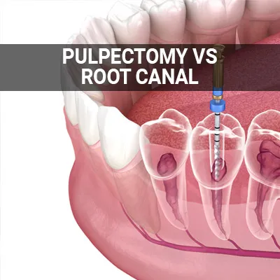 Visit our Pulpectomy vs. Root Canal page