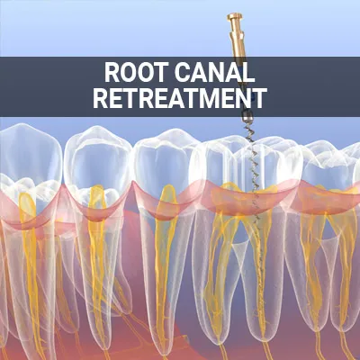 Visit our Root Canal Retreatment page